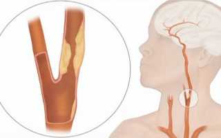 Симптомы стеноза шейного отдела позвоночника и его лечение