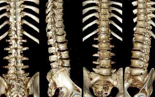 Проведение компьютерной томографии позвоночника