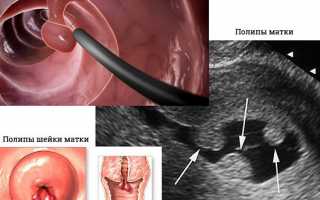 Причины образования полипов на шейке матки, их лечение и удаление