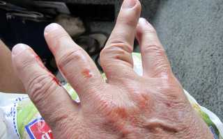 Признаки и методы лечения перелома пальца на руке