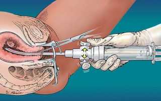 Эффективность вакуумного удаления полипов матки, аналоги метода и реабилитация