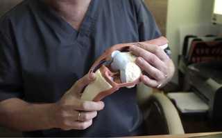 Проявление разрыва связок коленного сустава и его лечение