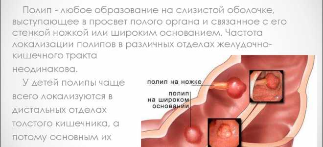 Отличие кисты от полипа и возможные осложнения после их появления