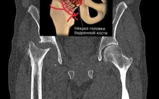 Виды некроза тазобедренного сустава и его лечение