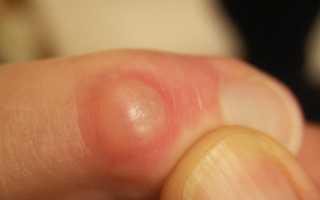 Признаки и методы устранения гигромы на пальце руки