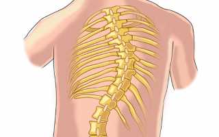 Можно ли вылечить сколиоз 4 степени без операции?