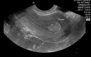 Как выглядят на УЗИ полипы в матке и эндометрии с кровотоком