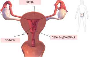 Методы лечения полипа в матке и может ли он рассосаться самостоятельно