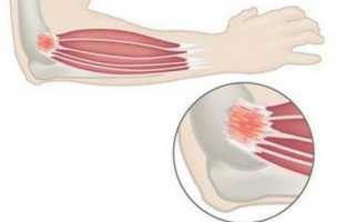 Как определить и лечить растяжение локтевого сустава