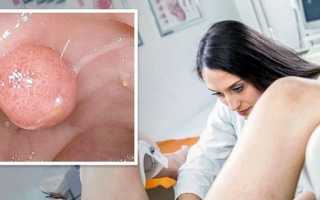 Возможно ли лечение полипа эндометрия без операции и что важно знать