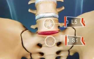 Почему возникает грыжа диска L5-S1 и как ее лечить?