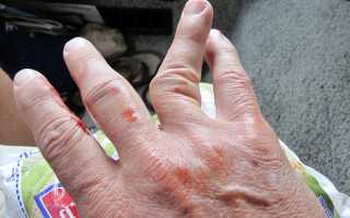 Признаки вывиха пальца на руке и способы его лечения