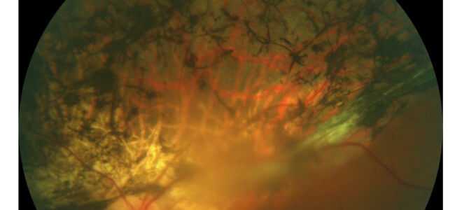 Пигментная абиотрофия сетчатки