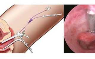 Сколько стоит удаление полипа шейки матки, в матке и в эндометрии