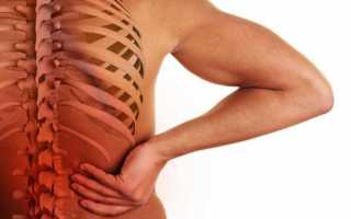 Симптомы хондроза спины и способы его лечения