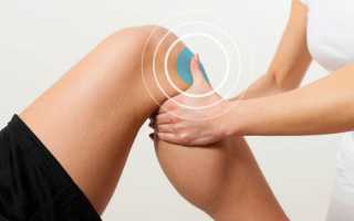 Признаки и лечение растяжения связок коленного сустава