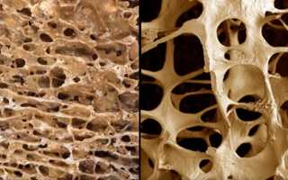 Чем отличается болезнь остеопороз от остеопении?
