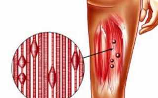 Проявление миофасциального болевого синдрома и его лечение
