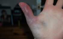 Что делать при ушибе пальца на руке в домашних условиях?