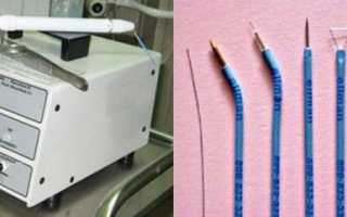 Как происходит удаление кондилом Сургитроном и чему уделить внимание после удаления