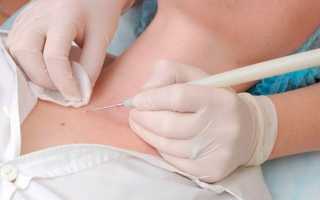 Как удаляют бородавки и другие новообразования Сургитроном и сколько это стоит