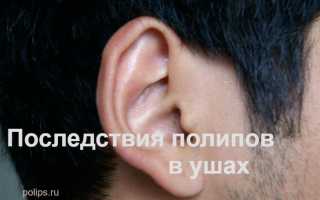 Последствия образования полипов в ухе и как их лечат