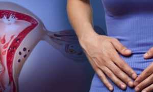 Симптомы полипов яичника, как их лечить и нужно ли удалять