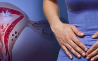 Симптомы полипов яичника, как их лечить и нужно ли удалять