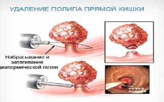 Как проходит операция по удалению полипов в кишечнике