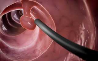 Как удаляют полипы в желудке и возможные послеоперационные осложнения