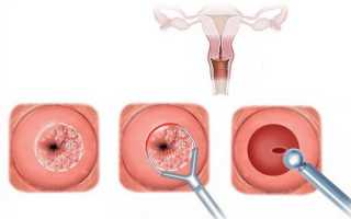 Стоимость биопсии шейки матки аппаратом Сургитрон и порядок её проведения