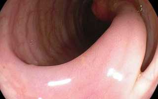 Классификация полипов в толстой кишке и как от них избавиться