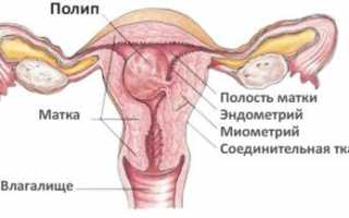 Лечение грануляционного полипа в наше время и почему он появляется
