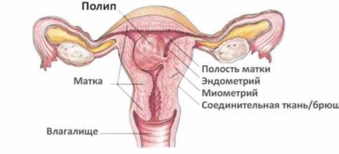 Лечение грануляционного полипа в наше время и почему он появляется