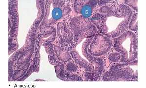 Виды аденоматозного полипа, их лечение и основная опасность