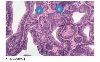 Виды аденоматозного полипа, их лечение и основная опасность