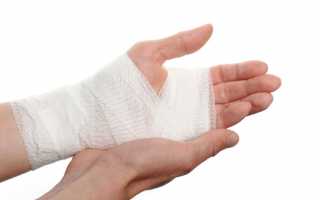 Особенности лечения растяжения связок кисти руки дома