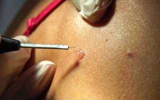 Стоимость удаления родинок Сургитроном и преимущества перед другими методами