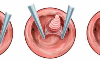 Как удалить полипы с шейки матки и почему это необходимо
