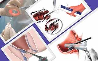 Устранение анальной трещины Сургитроном и другие операции в проктологии