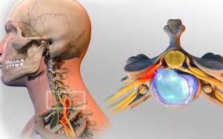 Почему развивается протрузия дисков С5–С6 и как ее вылечить?
