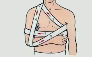 Правила наложения повязки Дезо на плечевой сустав