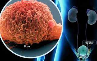 Причины возникновения и лечение полипов мочевого пузыря у взрослых и детей