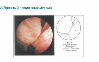 Методы лечения железисто-фиброзного полипа эндометрия и реабилитация после его удаления