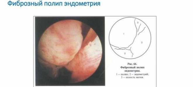 Методы лечения железисто-фиброзного полипа эндометрия и реабилитация после его удаления