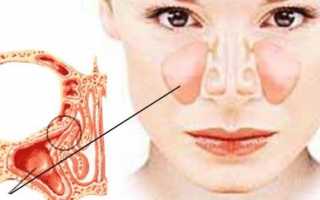 Особенности лечения полипов верхнечелюстной пазухи и возможные осложнения