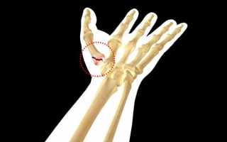 Признаки и лечение перелома большого пальца руки