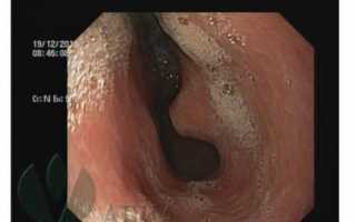 Лечение и удаление полипа антрального отдела желудка