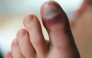 Признаки и лечение ушиба мягких тканей пальца ноги