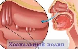 Причины, диагностика хоанального полипа и методы его лечения